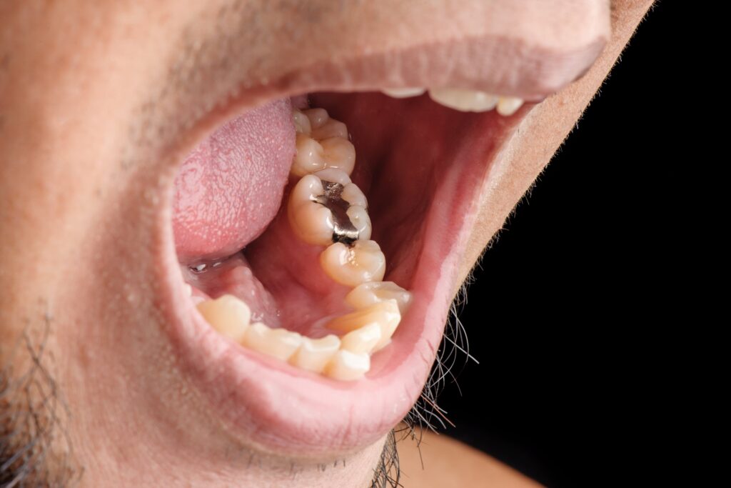 Close-up of open mouth showing amalgam filling