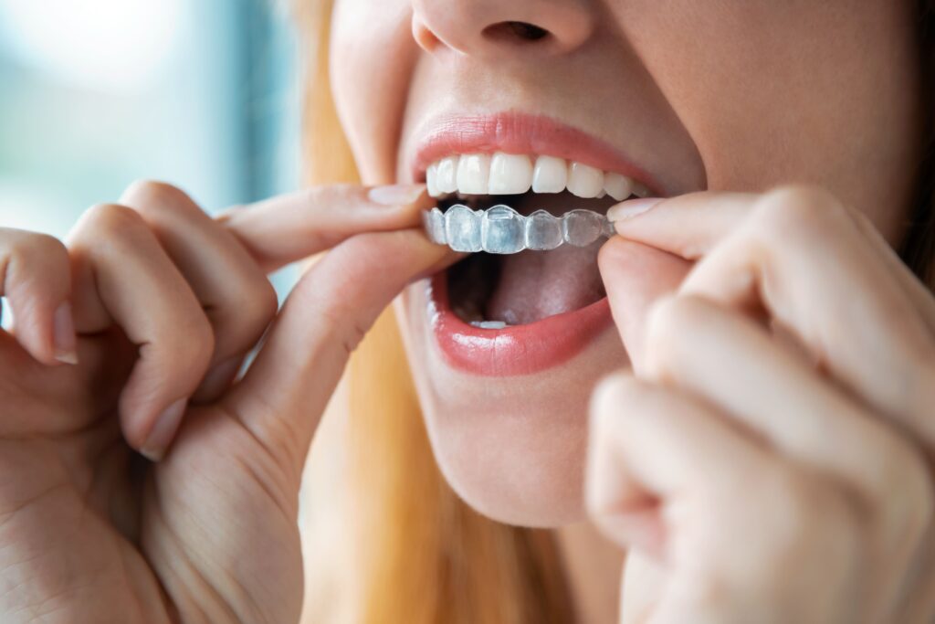 Young woman inserting invisalign aligner