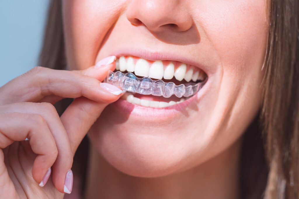 Close-up of young woman putting in invisalign aligner