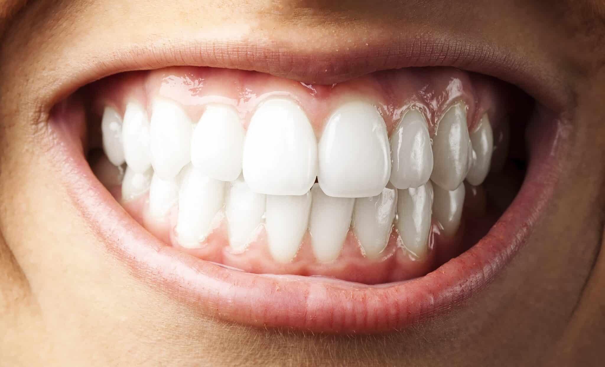 How Is Your Bite Supposed to Look? - Wilkinson Dental