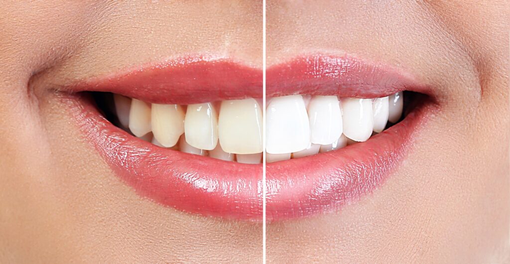 teeth whitening before and after