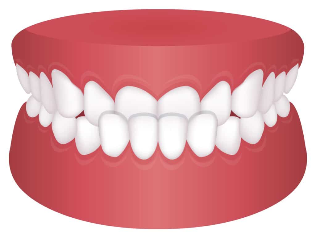 graphic illustration of underbite