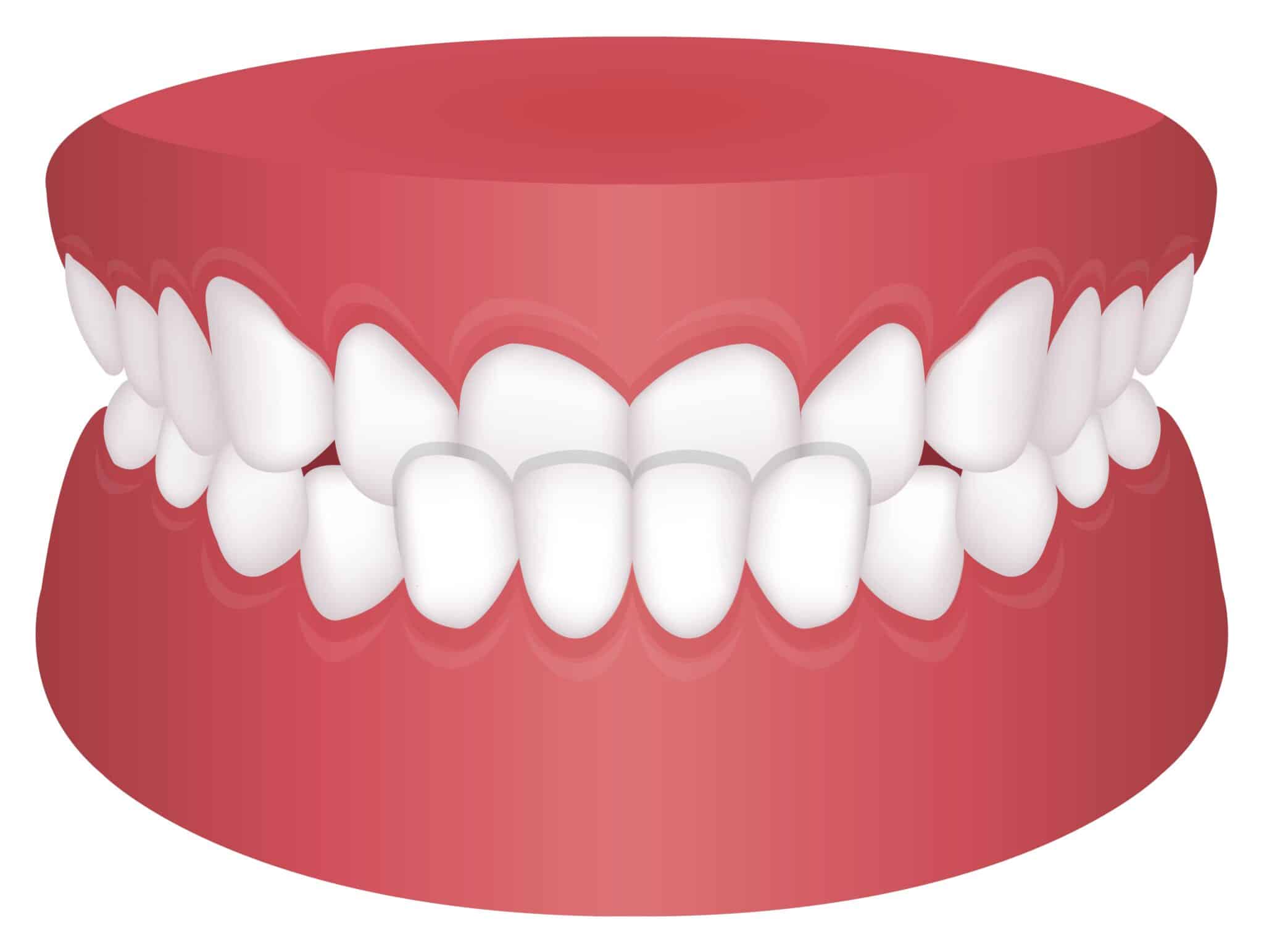How to Fix an Underbite Wilkinson Dental