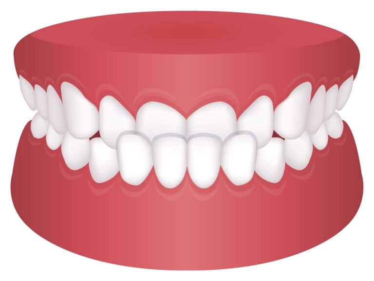graphic illustration of underbite