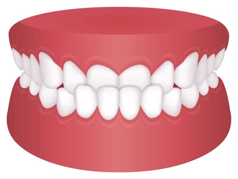 graphic illustration of underbite