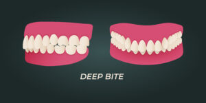 Graphic illustration of overbite aka deep bite, side and front views