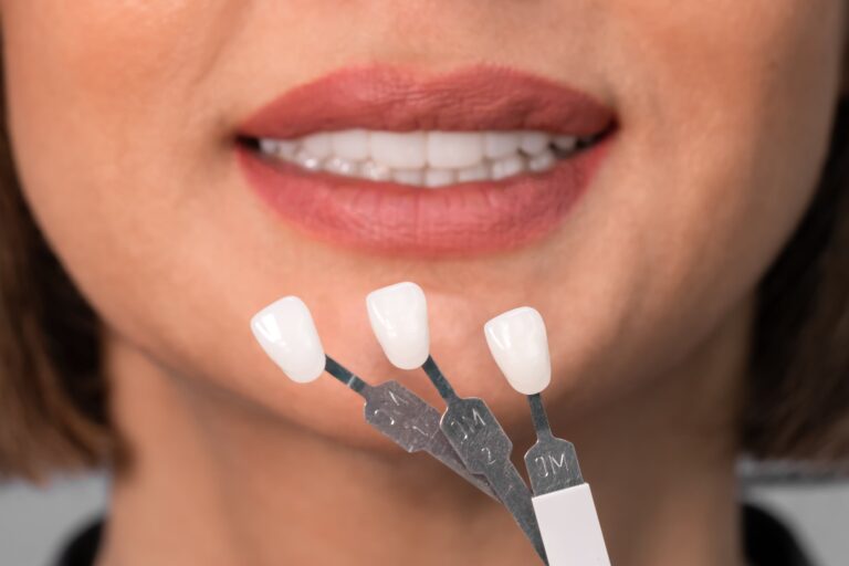 veneer samples held up to smile close-up