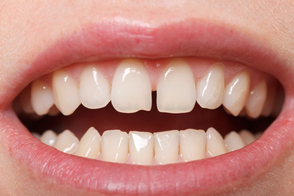 Close-up of gapped front teeth