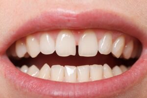 Close-up of gapped front teeth