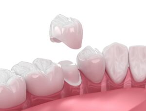 Medically accurate digital illustration of dental crown
